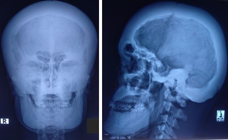 Marked cranial hyperostosis with endobone formation | JSEDM