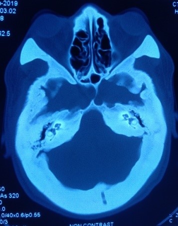 Cranial hyperostosis on CT scan of head | JSEDM