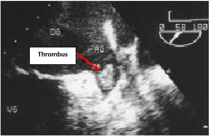 Transesophageal echocardiography