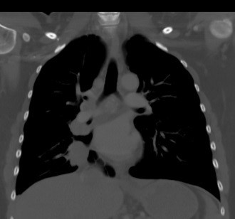 Coronal view of chest computed tomography demonstrating a 3.4 cm right lower lobe mass proven to be malignant (outlined).