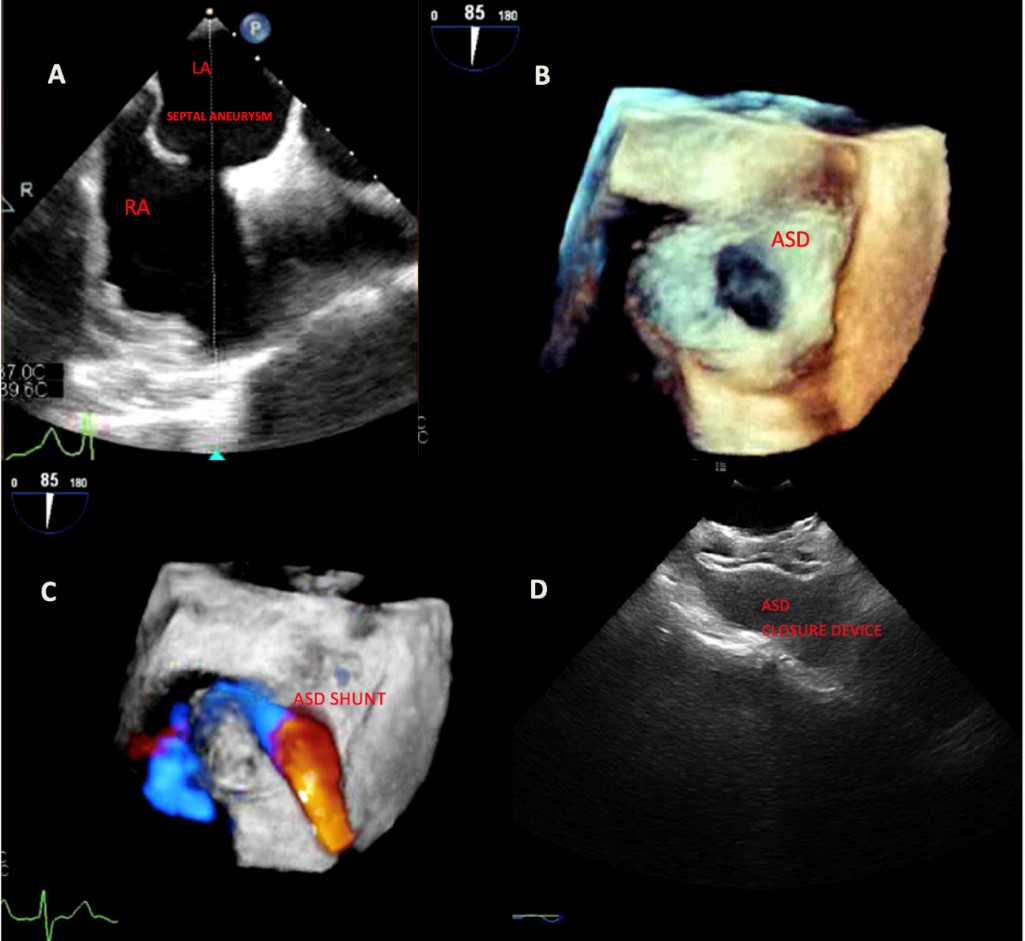 Transesophageal-echocardiography