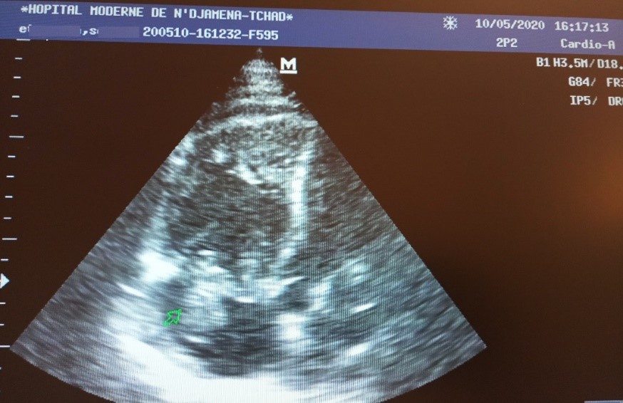 4-cavity section echocardiography showing the right intraatrial thrombus