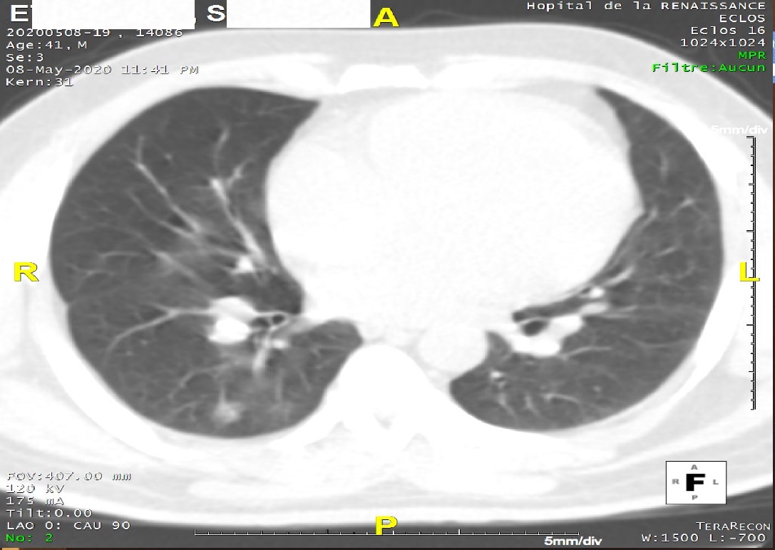 Figure 2: CT scan presenting pulmonary ground-glass opacities.