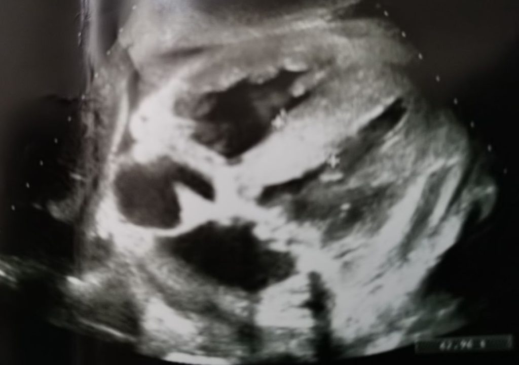 Figure 1: Epigastric scan. Macroscopic thickening of the interventricular septum, severe thickening of the left and right ventricles walls, biatrial dilatation, and irrelevant pericardial effusion.