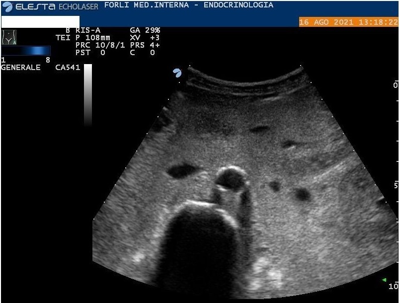 Figure 2: Abdomen ultrasound. Diffuse amorphous slightly hyperechoic material in peritoneum and mesentery.