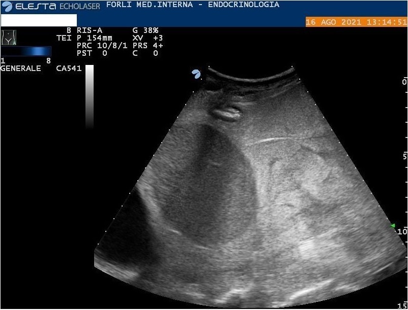 Figure 3: Abdomen ultrasound. Diffuse amorphous slightly hyperechoic material in the perisplenic region.