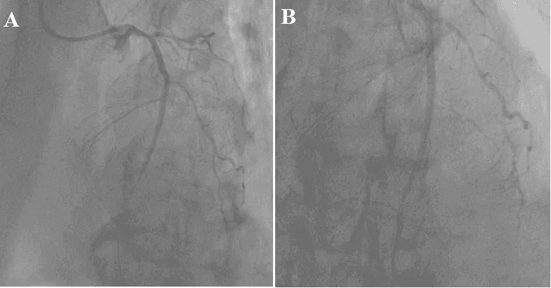 Figure 3: (A, B) Antegrade blood flow restored by TIMI-3 after implantation of 2 stents