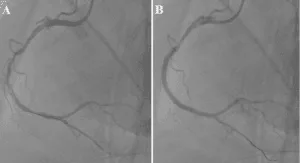 Figure 4: A - RCA after balloon angioplasty, B - RCA after stents implantation