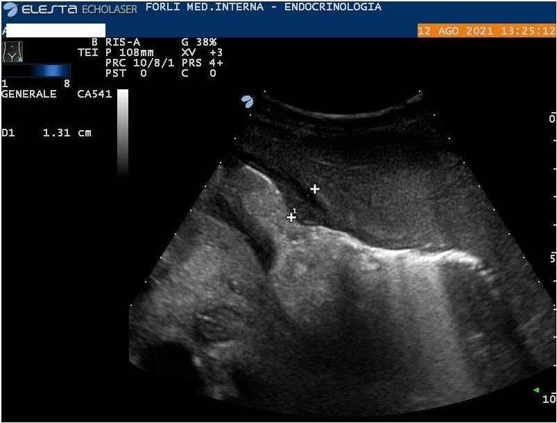 Figure 4: Abdominal ultrasound. Amorphous material in the abdomen, around the stomach wall.