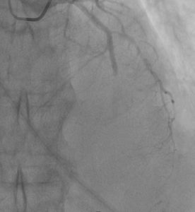 Figure 5: Acute stent thrombosis in coronary angiography of the LAD, the phenomenon of no-reflow