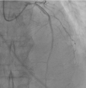 Figure 6: Control coronary angiography after intracoronary eptifibatide administration. Regression of the no-reflow phenomenon. Blood flow of LAD TIMI-3, MBG-2.