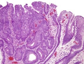 Gastric adenoma depicting glandular articulations lined with pseudostratified mucus secreting columnar epithelium with focal dysplasia, hyperchromatic nuclei, and cellular pleomorphism 