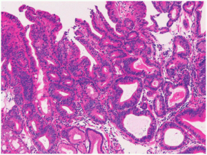 Figure 2: Gastric adenoma delineating villous and glandular articulations lined with pseudostratified, mucus secreting columnar epithelium with delicate, inflamed, intervening lamina propria and red cell extravasation [6].