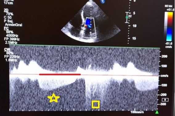 Figure 1: Continuous Doppler on the mitral valve shows regurgitation in the diastolic phase (yellow star) and systolic phase (yellow square).