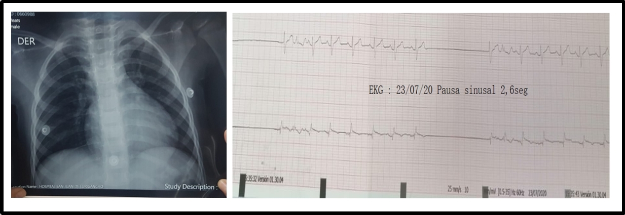 Figure 1: A 3-year-old patient with COVID-19. The X-ray shows a cardiothoracic ratio of 0.52 and ECG with node disease (sinus pauses 2,6 sec).