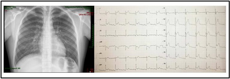 Figure 2: A 14-year-old patient with COVID-19 and acute pericarditis. The X-ray shows a cardiothoracic ratio of 0.50 and ECG with ST-segment elevation.