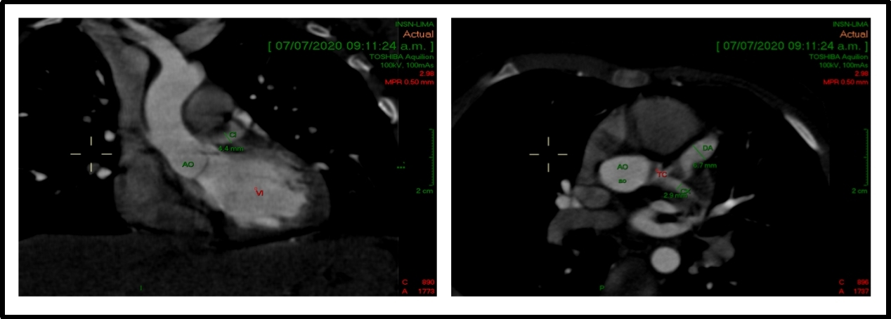  Figure 5: A 2-year-old patient with Kawasaki disease and coronary alterations. A cardiac CT and echocardiogram show a coronary artery aneurysm in LCA (z score +4.7).