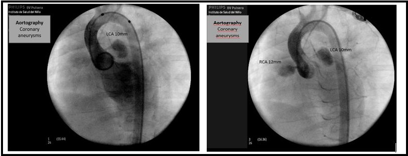 Figure 6: A 3-year-old patient with Kawasaki disease and severe coronary alterations. The aortography shows coronary artery aneurysm of the RCA (right coronary artery) (z score +4.9) and LCA (left coronary artery) (z score +5.6).