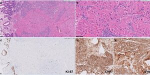 Figure 1: Low grade neuroendocrine tumor with oncocytic features. (a) H&E stain under 10X magnification showing oncocytic NET in the gastric submucosa. (b) H&E stain under 40X magnification showing tumor cells with abundant eosinophilic granular cytoplasm, smooth nuclear membranes, and prominent nucleoli. (c) The Ki-67 proliferative index is low (< 3%). (d) The tumor cells are positive for chromogranin (CHR). (e) The tumor cells are positive for synaptophysin (SYN).