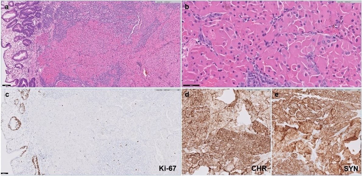 Clinicopathological Characteristics and Prognosis of 91 Patients