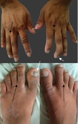 Syndactyly (black arrow) and nail hypoplasia (white arrow) are markers of sclerosteosis | JSEDM