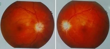 Bilateral optic atrophy due to entrapment neuropathy | JSEDM