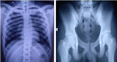 Diffuse sclerotic changes in all bones of pectoral and pelvic girdles | JSEDM