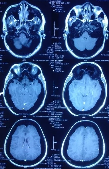 Normal MRI of brain | JSEDM