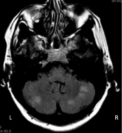 Brain magnetic resonance imaging/magnetic resonance angiography with evidence of infarcts in right and left cerebellar hemispheres (outlined). L: left; R: right.