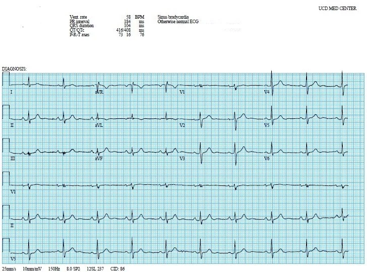 Electrocardiogram with sinus bradycardia.