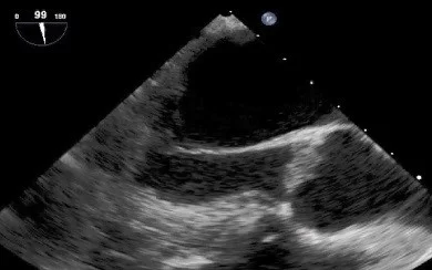 Transesophageal echocardiography revealing small, irregular vegetations on the aortic valve (arrows). LV: left ventricle; AO: ascending aorta.