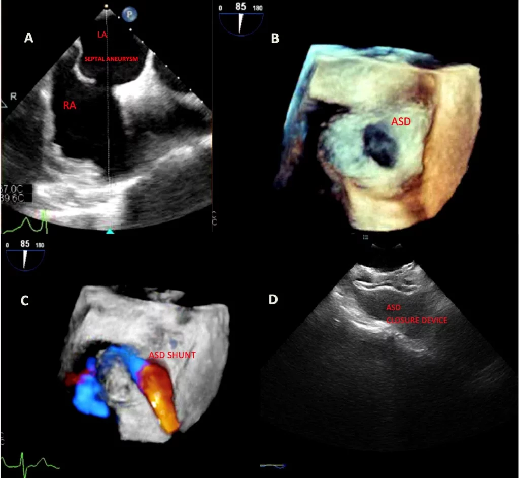 Transesophageal-echocardiography