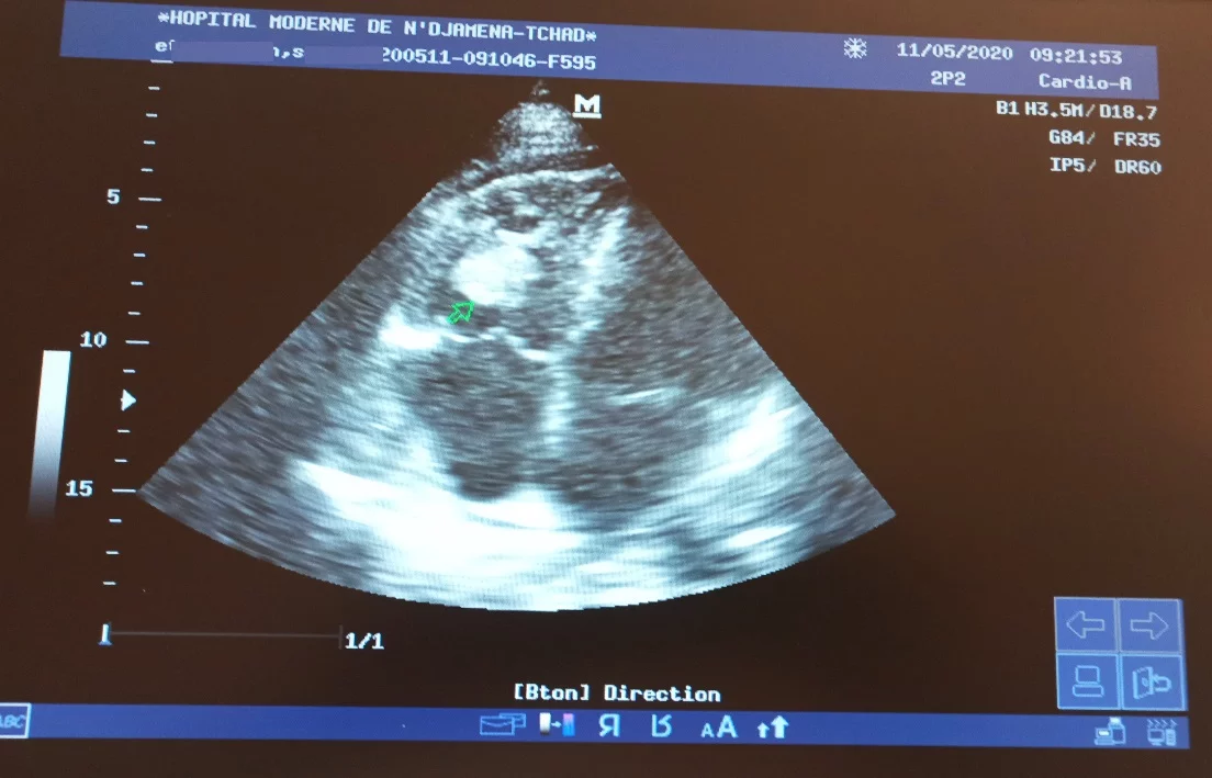 4-cavity section echocardiography showing the migration of the thrombus to the right ventricle.