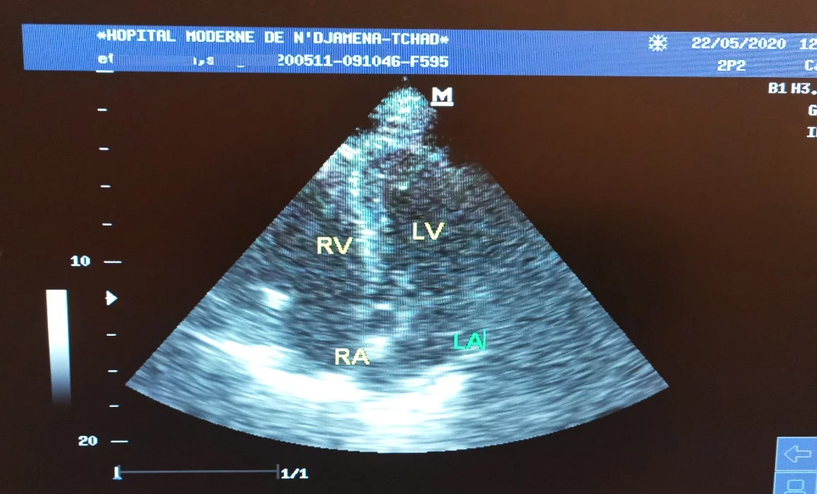 4-cavity section echocardiography presenting the complete regression of the thrombus.