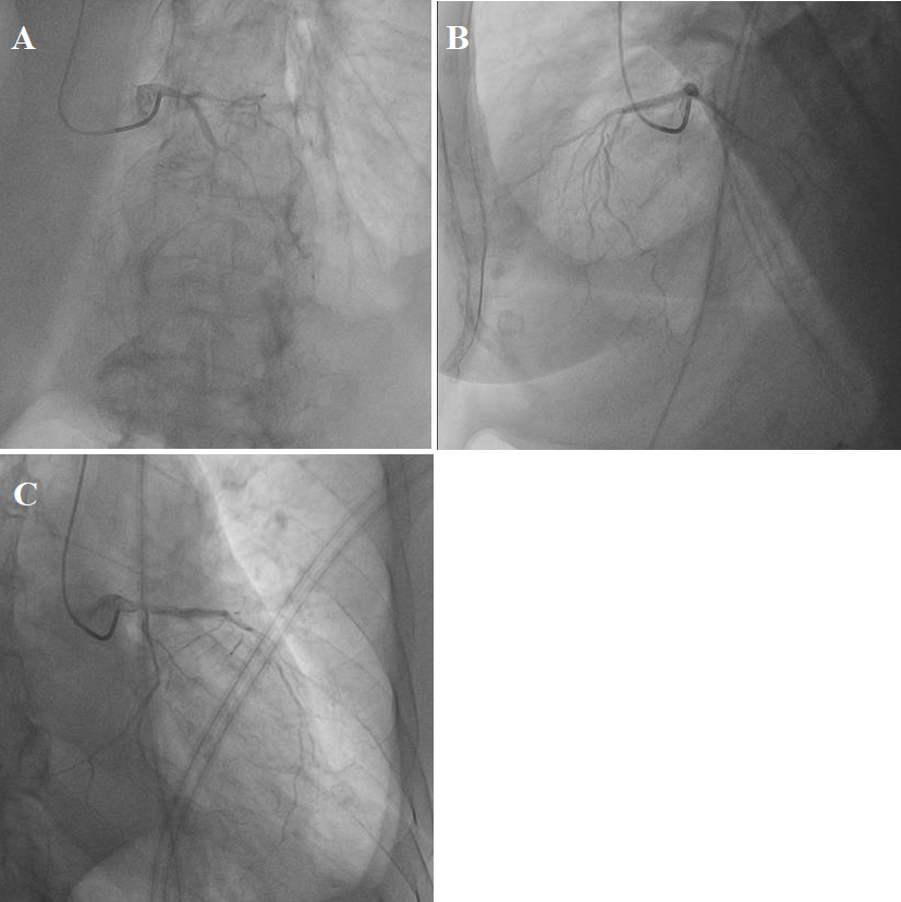 Figure 1: (A, B, C) Coronarography LCA, thrombotic occlusion LAD