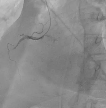 Figure 2: Coronarography RCA, thrombosis of the middle portion of the RCA