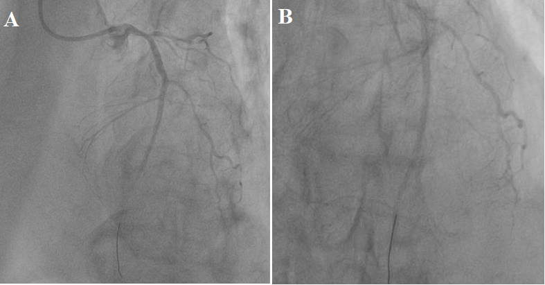 Figure 3: (A, B) Antegrade blood flow restored by TIMI-3 after implantation of 2 stents