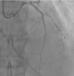 Figure 6: Control coronary angiography after intracoronary eptifibatide administration. Regression of the no-reflow phenomenon. Blood flow of LAD TIMI-3, MBG-2.