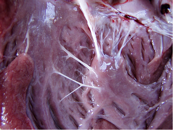 Figure 1: Note white spots in the opened left ventricle.