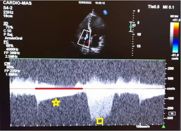 Figure 2: Continuous Doppler on the tricuspid valve shows regurgitation in the diastolic phase (yellow star) and systolic phase (yellow square).