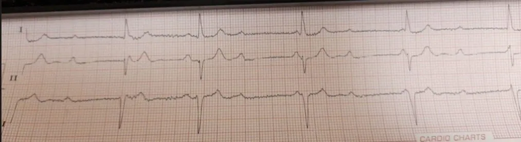 Figure 3: An electrocardiogram showing a complete atrioventricular block.