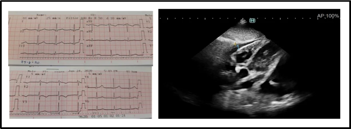 Figure 3: A 6-year-old patient with COVID-19 and acute pericarditis. ECG without significant change in ST-segment and the echocardiogram with mild pericardial effusion.