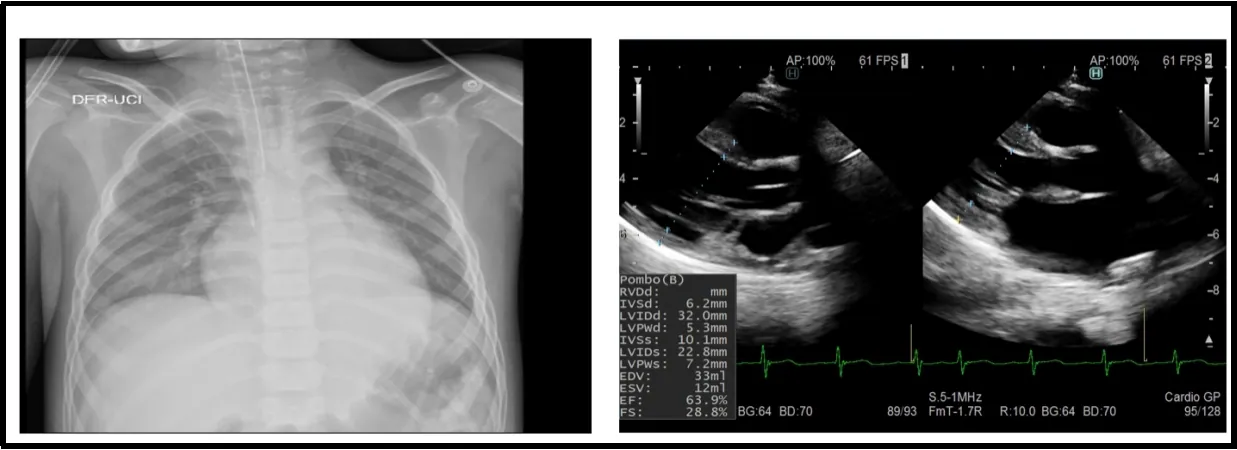 Figure 4: A 9-year-old patient with multisystem syndrome associated with COVID-19. The X-ray shows a cardiothoracic ratio of 0.60 and the echocardiogram with a transient compromise of left ventricular systolic function (FE: 51–63.9%).