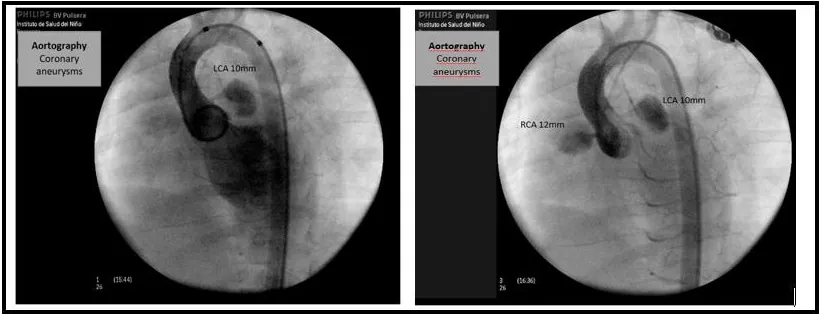 Figure 6: A 3-year-old patient with Kawasaki disease and severe coronary alterations. The aortography shows coronary artery aneurysm of the RCA (right coronary artery) (z score +4.9) and LCA (left coronary artery) (z score +5.6).