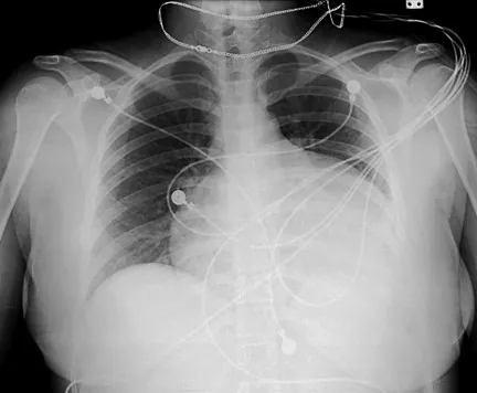 Figure 3: Pericardial effusion in a hypothyroid patient