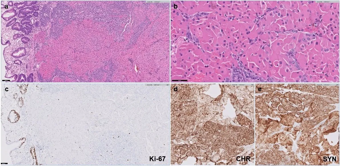 Figure 1: Low grade neuroendocrine tumor with oncocytic features. (a) H&E stain under 10X magnification showing oncocytic NET in the gastric submucosa. (b) H&E stain under 40X magnification showing tumor cells with abundant eosinophilic granular cytoplasm, smooth nuclear membranes, and prominent nucleoli. (c) The Ki-67 proliferative index is low (< 3%). (d) The tumor cells are positive for chromogranin (CHR). (e) The tumor cells are positive for synaptophysin (SYN).